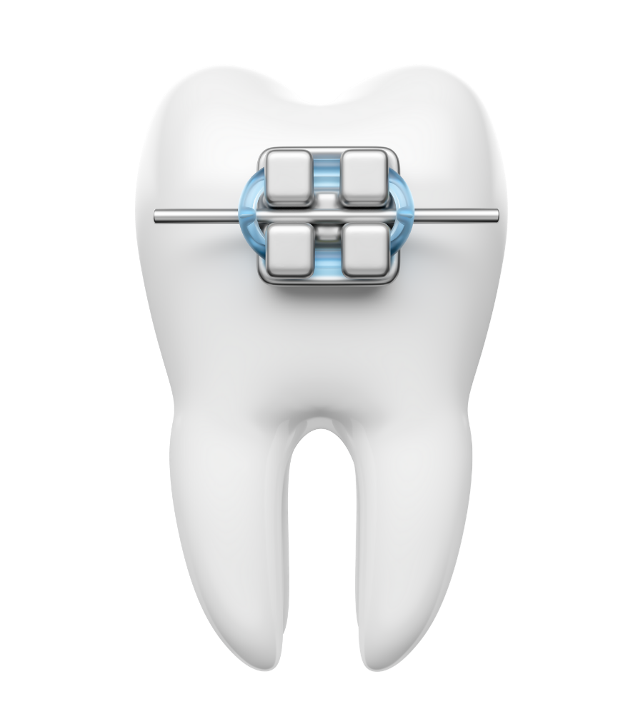 NIỀNG RĂNG CHỈNH NHA