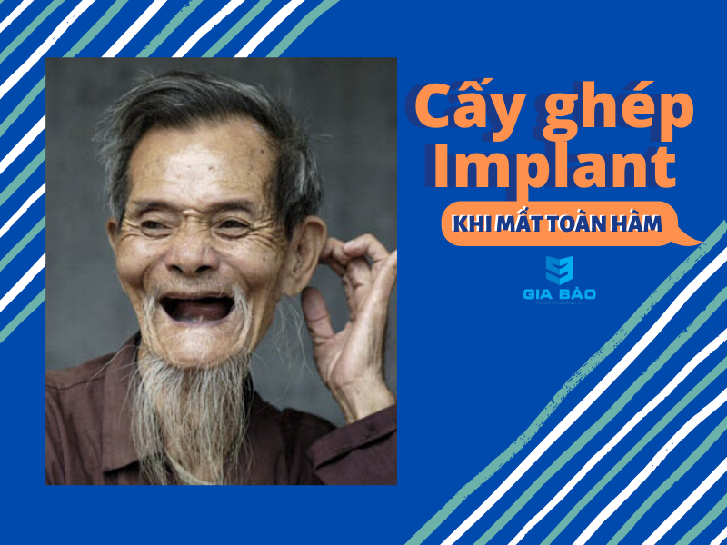 cay-implant-khi-mat-toan-ham