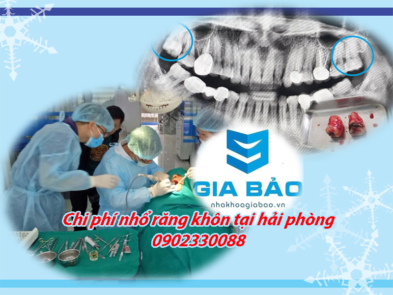 Giá nhổ răng khôn bằng máy tại hải phòng