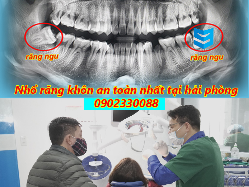 Nhổ răng khôn an toàn nhất tại hải phòng