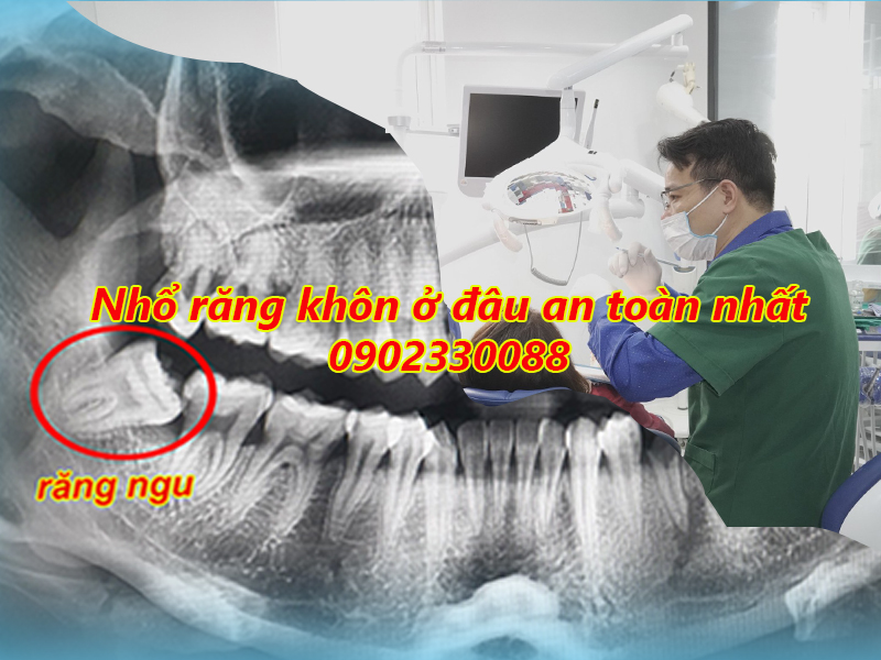 Nhổ răng khôn ở đâu là an toàn nhất