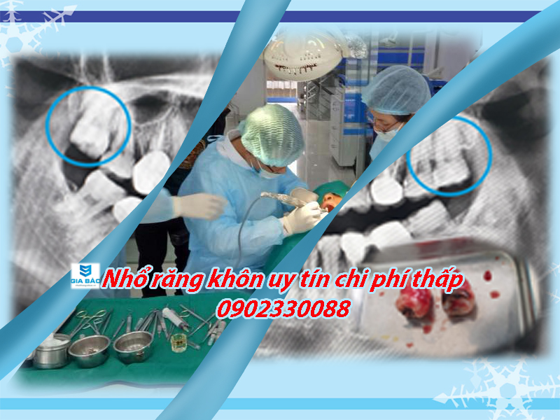 Nhổ răng khôn chi phí thấp tại hải phòng